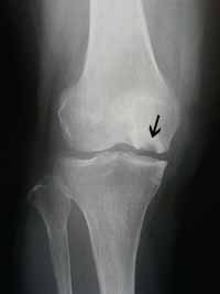 膝の痛み 間庭整形外科